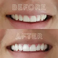 LED Teeth Whitening Kit with 56 Strips thumbnail 2