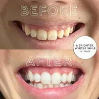 Platinum Teeth Whitening Kit with LED Light thumbnail 3