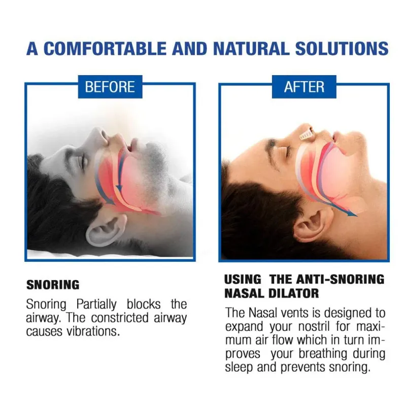 12-Piece Anti Snoring Nose Vents Set 2