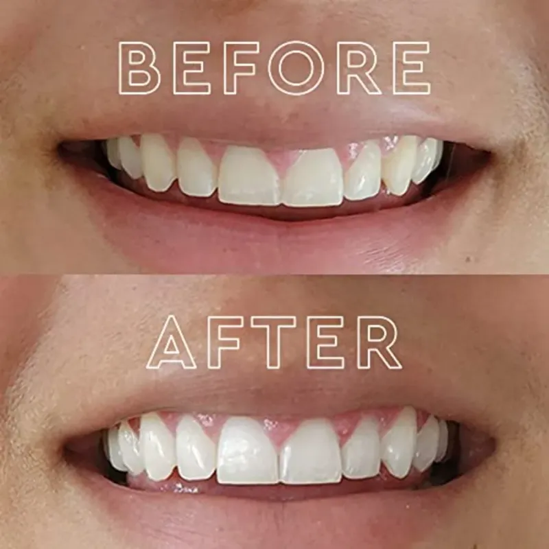 LED Teeth Whitening Kit with 56 Strips 2