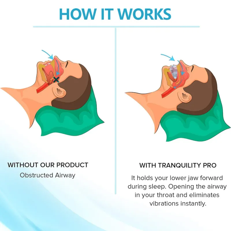 Anti Snoring & Bruxism Mouth Guard 5
